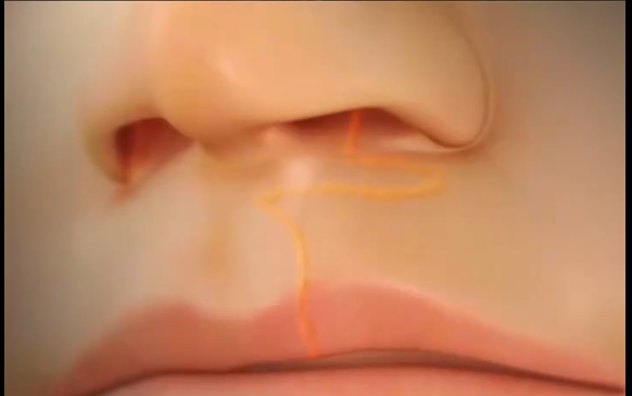 發(fā)現(xiàn)孩子唇裂？不要慌！余文林醫(yī)生的專業(yè)解答 