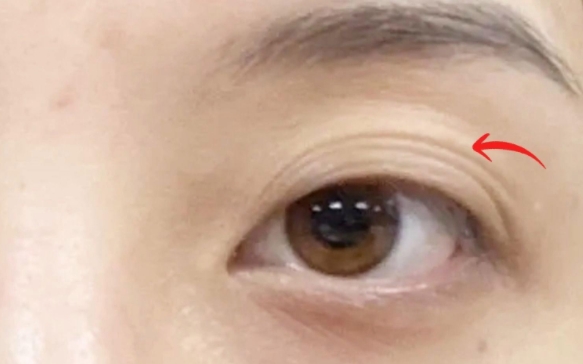 周顯玉醫(yī)生解析：多層雙眼皮提眉為何效果不佳？ 