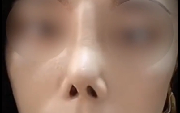 為什么隆鼻手術(shù)的翻車率居高不下？揭秘這幾個(gè)細(xì)節(jié)你必須知道！