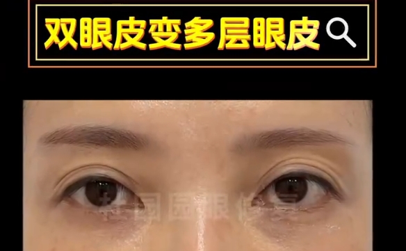 多層雙眼皮成因解答：杜園園醫(yī)生分享專業(yè)觀點(diǎn)