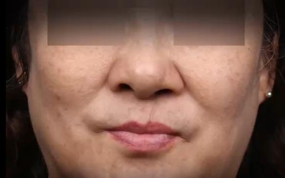 62歲第一次做唇裂修復，余文林醫(yī)生案例分享