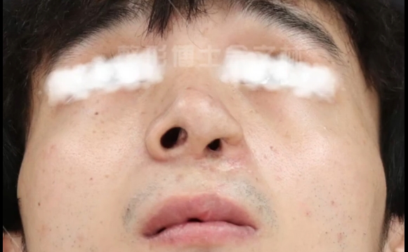 唇裂鼻修復(fù)：為何結(jié)果塌了？余文林醫(yī)生解析 