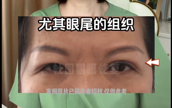 雙眼皮線條過長困擾？上海愛尚麗格醫(yī)院線條修復專家?guī)湍?>
        </a></li>
       			<li><a href=