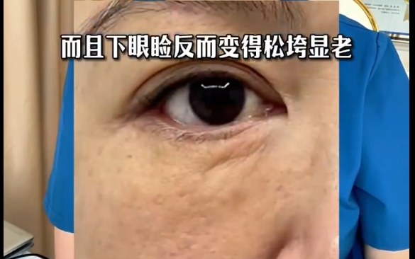 探究眼袋術(shù)后下瞼松垮的真正原因，杜園園醫(yī)生詳細(xì)解析 