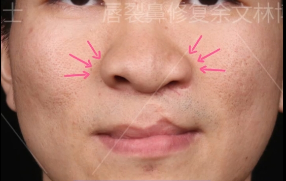 正鼻翼緣不對稱和患側(cè)唇峰上移問題？余文林醫(yī)生案例分享