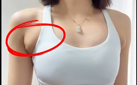 副乳可以通過脂肪抽吸解決嗎？程辰醫(yī)生告訴你