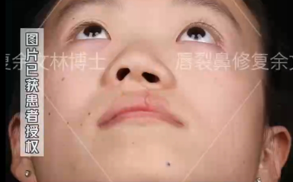 小時(shí)候的唇裂沒(méi)修復(fù)好會(huì)變成怎樣？余文林醫(yī)生解析