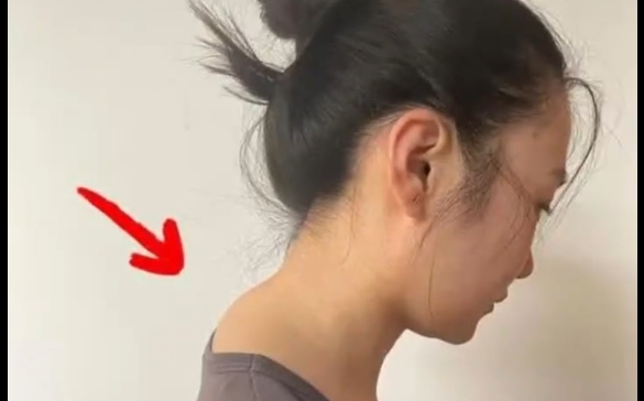 富貴包大揭秘！程辰醫(yī)生為您解讀