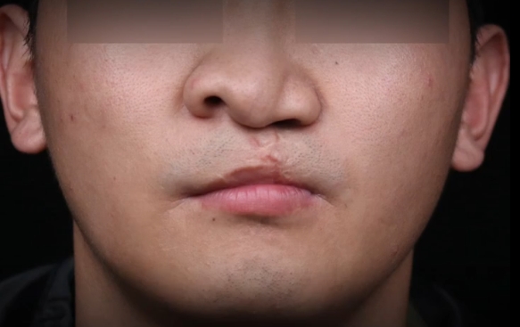 嚴重唇裂鼻，口鼻漏1.5cm怎么辦？余文林醫(yī)生帶您揭秘