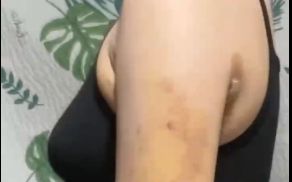吸脂后四個階段，哪個更難受？