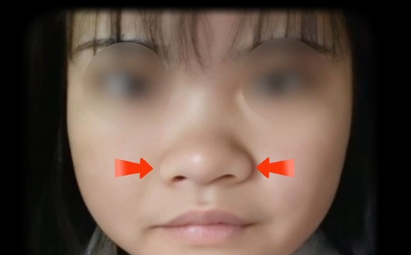 魏皎醫(yī)生解密：如何讓鼻子自然縮小，告別不滿意的鼻翼 