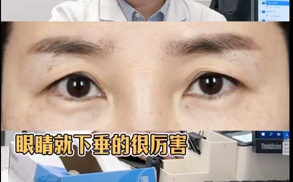 40歲眼皮下嚴重下垂，雙眼皮or提眉？
