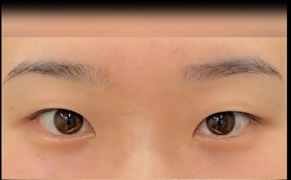 十個眼角九個疤是真的嗎？馮少清醫(yī)生在線解答