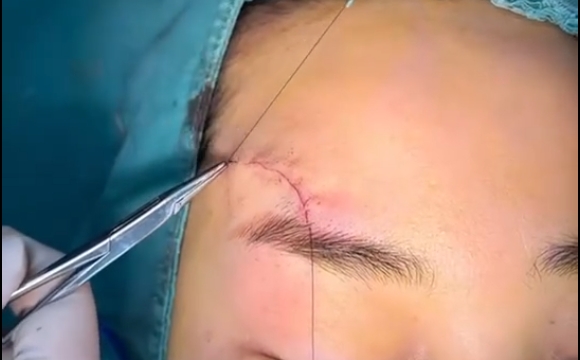 疤痕愈合后好不好看，關(guān)鍵看這4點，馮少清醫(yī)生解答