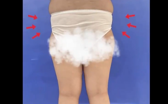 大腿環(huán)吸+臀部填充，一次解決多個問題，程辰醫(yī)生案例分享