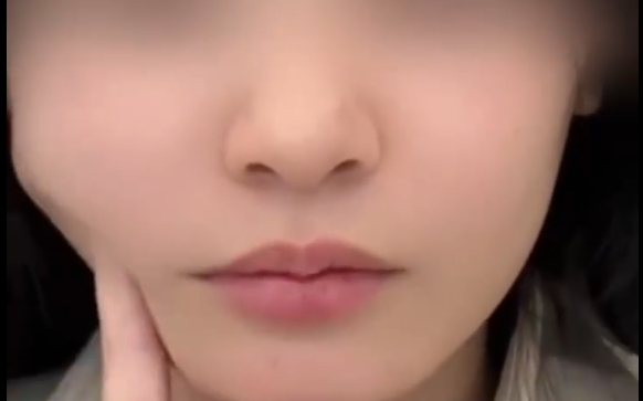 程辰醫(yī)生揭秘下頜緣術(shù)：如何避免垮臉尷尬？