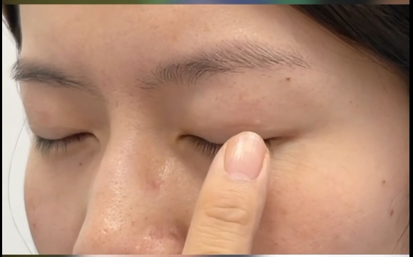 腫眼泡雙眼皮做對這點不踩坑！