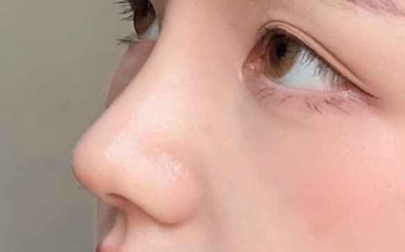 感染？穿出？不好??？膨體隆鼻究竟能不能用