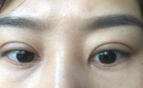 雙眼皮深如何修復，降窄能解決問題嗎？杜園園醫(yī)生回答你