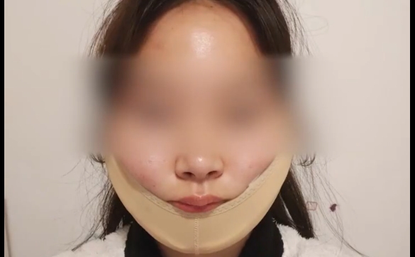 面部吸脂半年沒恢復？是這三點沒注意！程辰醫(yī)生在線解答