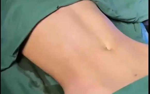 做完吸脂沒人好看？問題出在哪了？程辰醫(yī)生告訴你