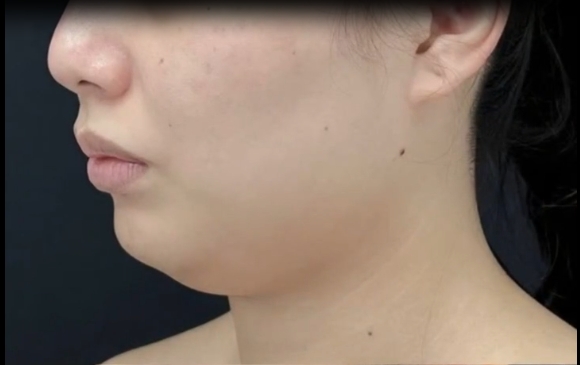 普通女孩兒的面部吸脂指南，程辰醫(yī)生帶你揭秘！ 