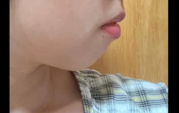 下巴后縮戴牙套還是做醫(yī)美？魏皎醫(yī)生揭秘