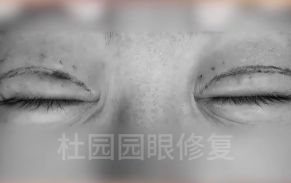 雙眼皮凹陷疤痕，里面發(fā)生了什么？杜園園醫(yī)生在線解答