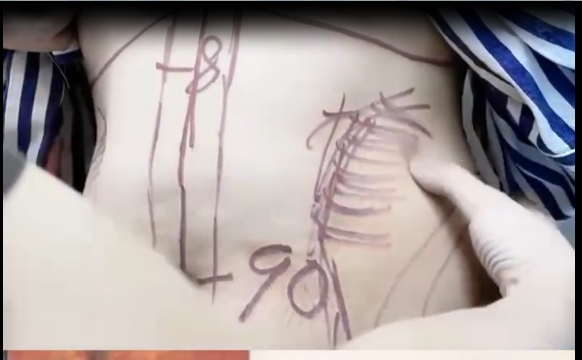 你真的了解吸脂前為什么要畫(huà)線嗎？程辰醫(yī)生給出答案！ 