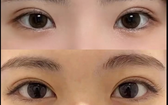 哪種雙眼皮更適合亞洲人？