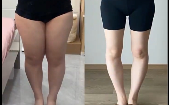 腿彎和腿粗，哪個才是腿型的“致命傷“？程辰醫(yī)生解答