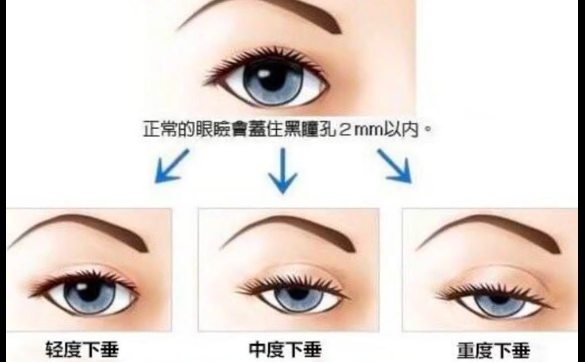 上瞼下垂是全麻嗎？怎么配合？周顯玉醫(yī)生解答