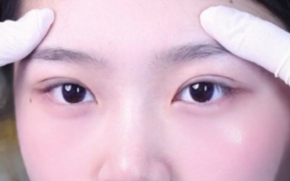 雙眼皮手術(shù)：如何打造開扇雙眼皮？周顯玉醫(yī)生案例分享