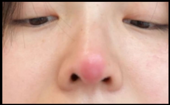 隆鼻之后攣縮，這樣修復(fù)效果好！魏皎醫(yī)生解答
