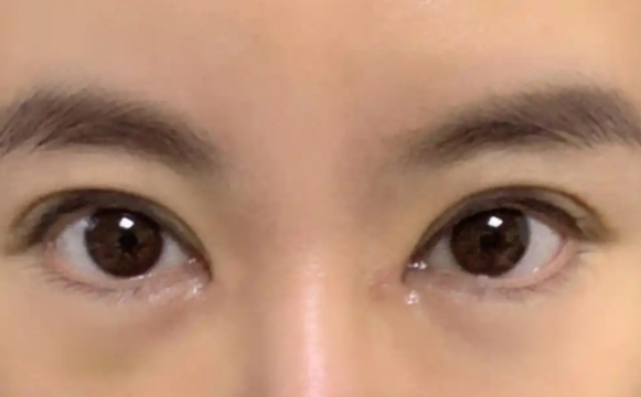 包眼角失敗還能再修復(fù)嗎？杜園園醫(yī)生解答