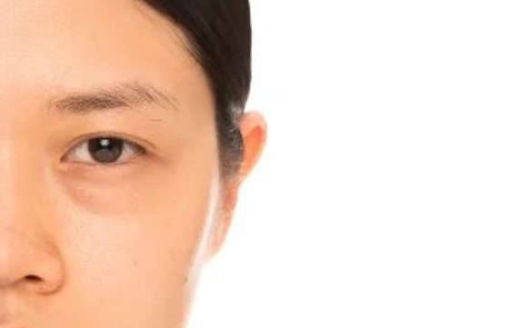 改善眼袋淚溝，為什么推薦眶隔脂肪釋放？周顯玉醫(yī)生告訴你