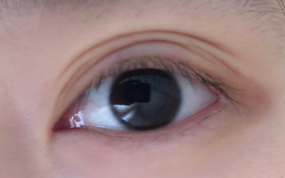 雙眼皮術后出現(xiàn)多層雙眼皮是什么情況？