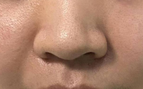 千萬不要外切你的鼻翼，讓你的鼻頭自然縮小