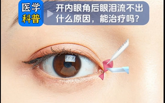 開內眼角后，眼淚流不出的原因及修復方法