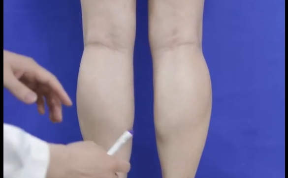 瘦腿針？吸脂？到底哪個(gè)方式可以改善小腿粗？