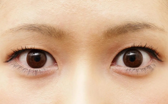 所有上瞼下垂都會(huì)遺傳嗎？周顯玉醫(yī)生為你解答