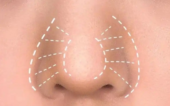 縮鼻翼再好，這3種人統(tǒng)統(tǒng)勸退！