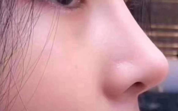 鼻背長痘一直沒有消，醫(yī)生：別扣了，線穿出來了！