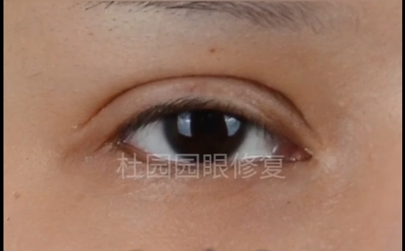 中重度上瞼下垂修復(fù)后，還會(huì)復(fù)發(fā)？杜園園醫(yī)生為你解答