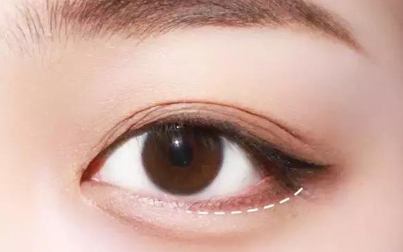 微創(chuàng)手術做出來的臥蠶是永久的嗎？