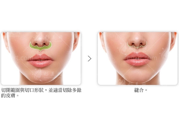 人中縮短術(shù)六個月效果圖對比