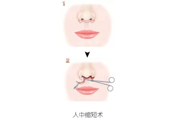 人中縮短術(shù)長期效果跟蹤對比