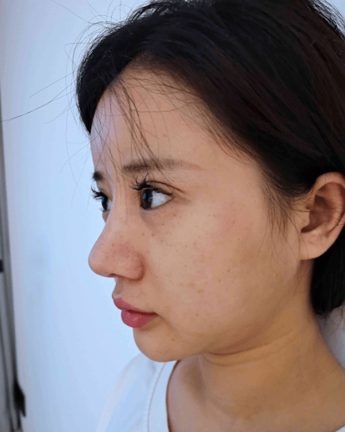 * 主題 重慶星宸醫(yī)院隆鼻怎么樣？真實(shí)隆鼻案例分享及價(jià)格表
