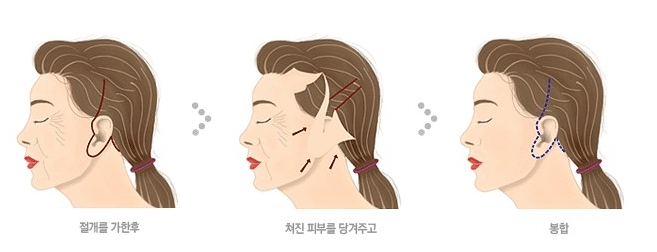 大拉皮和小拉皮手術(shù)的區(qū)別在哪里？效果維持時間多久？