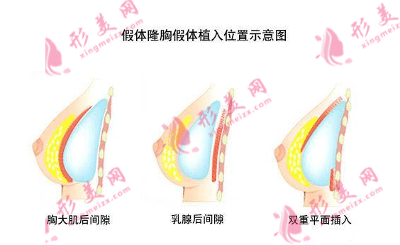假體隆胸多少錢？做假體隆胸需要注意什么?